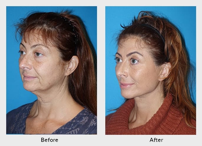 Learning The Difference Between Skin Tightening and Soft Lift